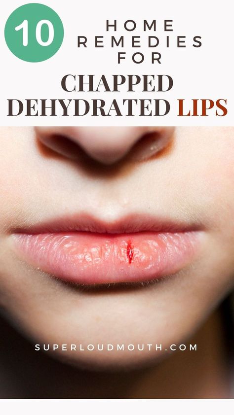 10 Home remedies you can try for dry and dehydrated Lips Dehydration Remedies, Dry Lips Remedy, Chapped Lips Remedy, Dehydrated Lips, Home Remedies For Skin, Lip Care Routine, Brown Spots Removal, Natural Cold Remedies, Peeling Skin