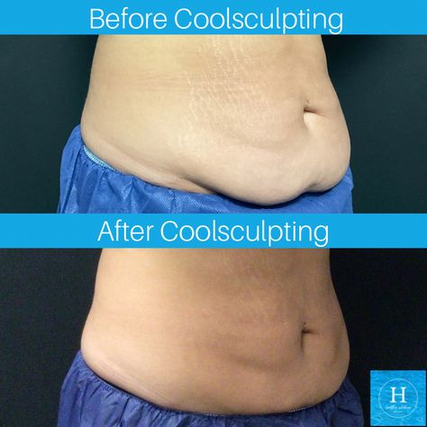 Coolsculpting before and after photo belly fat reduction Cryo Sculpting Before And After, Chin Lipo Before And After, Facial Lipo Before And After, Lipo Suction Before And After, Coolsculpting Before And After, Lipo 360 After Care, Body Change, New Hope Pa, Cool Sculpting