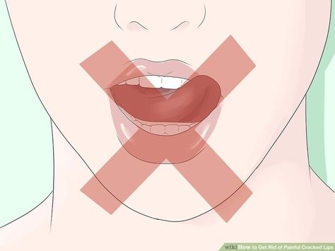 How to Get Rid of Painful Cracked Lips (with Pictures) - wikiHow Sore Lips, Cleopatra Beauty Secrets, Beauty Hacks Eyelashes, Dry Cracked Lips, Beauty Hacks Lips, Dry Skin Remedies, Cracked Lips, Serious Illness, Skin Remedies