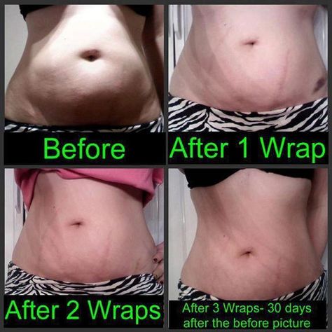 IT WORKS Body Wraps Before and After - Stomach Look at my website https:// kimzsecret.myitworks.com Itworks Wraps, Body Wrapping, Fitness Before And After Pictures, It Works Body Wraps, It Works Wraps, Inch Loss, It Works Products, Crazy Wrap Thing, Lose Inches