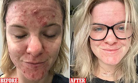 Woman struggling with severe acne reveals how she improved her skin Head Acne, Back Acne, Anti Redness, Severe Acne, Cystic Acne, Remove Acne, Natural Face, Brightening Serum, Without Makeup