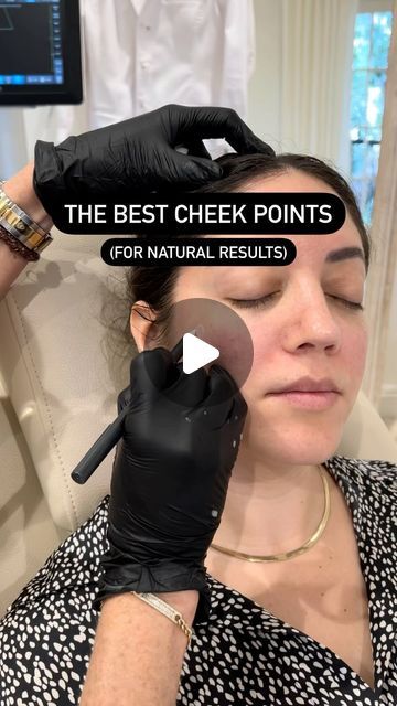 Cheek Filler Placement, Midface Cheek Filler, Cheek Implants Before And After, Facial Contouring Fillers, Cheekbone Filler Before And After, Cheek Fillers Before And After Face, Cheek Wrinkles, Cheek Implants, Under Eye Fillers