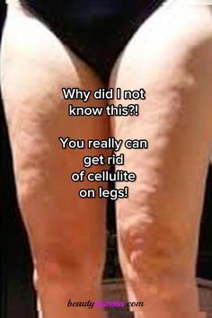 Wish i knew this before - simple natural remedies for legs with cellulite! How To Get Rid Of Leg Dimples, Tighten Leg Skin, Tighten Thigh Skin, Saggy Legs Workout, Firm Legs In Two Weeks, Cottage Cheese Legs How To Get Rid Of, How To Get Rid Of Cellulight, Exercise For Celulites, Fat Legs How To Get Rid Of