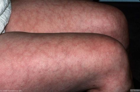 Livedo reticularis in lupus: https://plus.google.com/106749088806096753384/posts/iYSdrtwa9tb . Go to http://www.facebook.com/LupusEncyclopedia or follow me on Twitter at http://twitter.com/... to get daily tips on living with and fighting the symptoms of lupus and related problems such as arthritis, fibromyalgia, and Sjögren’s syndrome. It also answers questions such as “What is lupus?” and “What causes lupus?” Livedo Reticularis, Autoimmune Disease Symptoms, Sjogrens Syndrome, Disease Symptoms, Autoimmune Disorder, Skin Disorders, Chronic Fatigue, Autoimmune Disease, Alternative Medicine