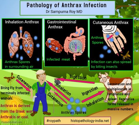 Anthrax is a rare acute infectious febrile septicemic disease caused by Bacillus anthracis, a large Gram-positive, spore-bearing bacillus which normally causes disease in animals. . . #roypath #pathology #histopathology #infectiondisease #anthrax #bacteria Anthrax Disease, Bacillus Anthracis, Respiratory Disorders, Medical Mnemonics, Childbirth Education, Infectious Diseases, Prenatal Yoga, Childrens Health, Newborn Care