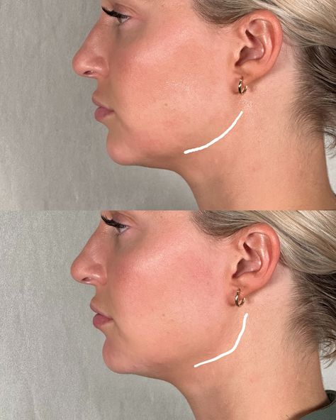 Jawline Before And After, Jawline Fillers Before And After, Perfect Nose, Nose Job, After Photos, To Share, Quick Saves