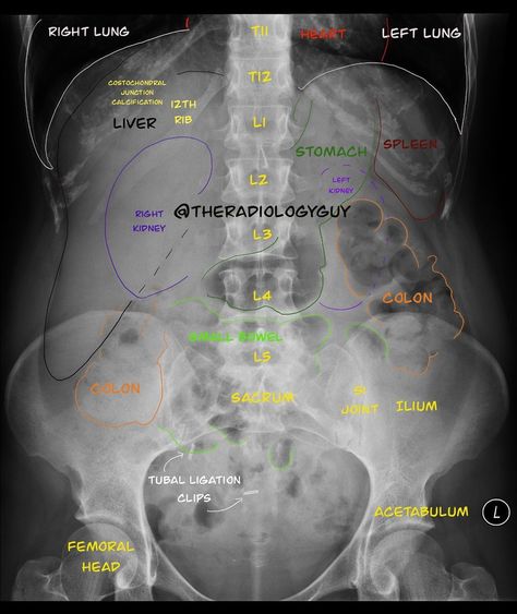 376 Me gusta, 5 comentarios - 𝕋𝕙𝕖ℝ𝕒𝕕𝕚𝕠𝕝𝕠𝕘𝕪𝔾𝕦𝕪 (@theradiologyguy) en Instagram: "The ABDOMEN X-RAY:  I alway found this exam to be tougher than the chest X-ray. So what do I look…" Radiology Schools, Medical Radiography, Vascular Ultrasound, Radiology Student, Radiology Technician, Radiology Imaging, Nursing School Essential, Medical School Life, Radiology Technologist