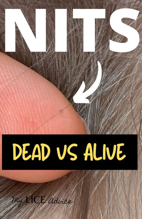 This article is loaded with pictures, to help you learn the different colors of lice eggs and how you can determine the difference between live and dead nits in the hair. #lice #nits #licecheck #superlice How To Get Rid Of Nits In Hair, How To Get Rid Of Lice Fast, Getting Rid Of Nits, Essential Oils For Lice, Nits Removal, How To Treat Lice, Lice Nits, Lice Remedies, Nursing Knowledge