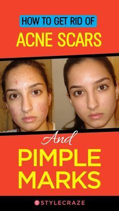 Forehead Acne, Treating Acne, Prevent Pimples, Get Rid Of Acne, Get Rid Of Warts, Rid Of Acne, Types Of Acne, How To Get Rid Of Pimples, How To Remove Pimples