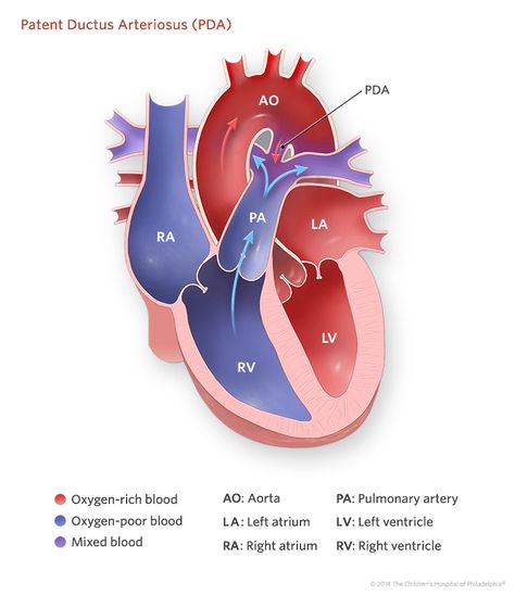 Patent Ductus Arteriosus Illustration Cardiology Notes, Cardiac Assessment, Patent Ductus Arteriosus, Patient Care Tech, Cardiac Sonography, Medical Terminology Study, Medical Laboratory Technician, Heart Defect, Congenital Heart Defect