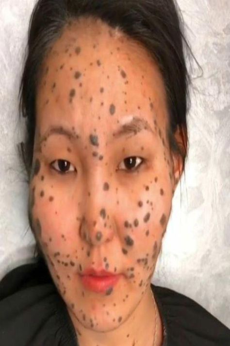 #NaturalSleepRemedies Squeezing Zits, Zit Popping Video Faces, Blackheads Removal Cream, Nose Pimples, Know Your Skin Type, Blind Pimple, Zit Popping Videos, Outdoor Pallet, Pimples On Face