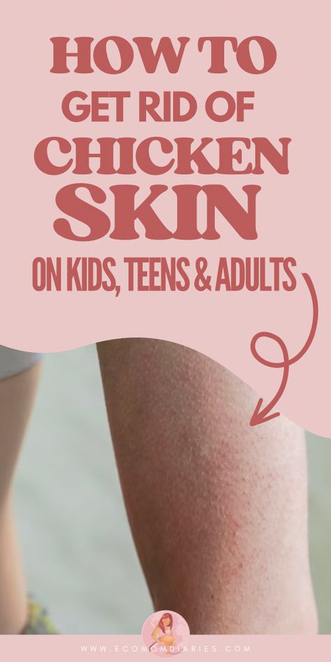 Small Bumps On Arms, Chicken Skin Remedy, Bumps On Arms, Keratosis Pilaris Remedy, Blind Pimple, Rough Bumpy Skin, Pimples Under The Skin, Acne Overnight, Skin Bumps