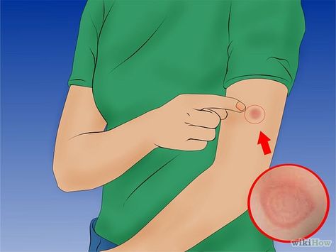 How to Recognize and Treat Ringworm Infection Ring Worm, Remedies For Dry Mouth, Home Remedies For Allergies, Home Remedies For Warts, Warts Remedy, Natural Remedies For Migraines, Allergy Remedies, Dry Skin Remedies, Skin Natural Remedies