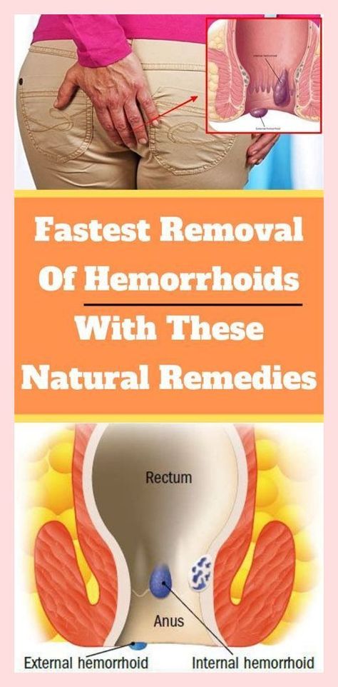 Fastest Removal of Hemorrhoids With These Natural Remedies ! Hemroid Relief Fast, Hemorrhoid Removal, Endocannabinoid System, Wallpaper Vintage, Invite Your Friends, Home Remedies, Natural Remedies, Health Care, Blog Posts