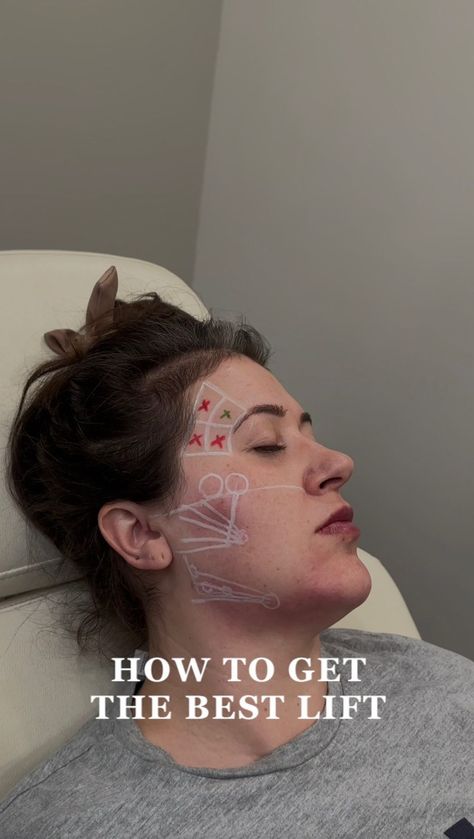 Riley Worth Henrichsen APRN, MSN, FNP-C, FNP-BC | These are the areas I LOVE to inject in order to get the best Lift for my patients using fillers! Temples Lateral cheeks Pre Auricular... | Instagram Filler Aesthetic, Botox Filler, Aesthetic Nurse, Aesthetic Dermatology, Cheek Fillers, Injectables Fillers, Facial Aesthetics, Nasolabial Folds, Botox Fillers