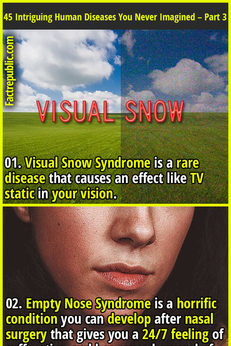 01. Visual Snow Syndrome is a rare disease that causes an effect like TV static in your vision. #health #science #knowledge #education #humanbody #diseases Interesting Medical Facts, Medical Facts Interesting, Visual Snow Syndrome, Visual Snow, Body Facts, Tv Static, Science Knowledge, Rare Genetic Disorders, Human Body Facts