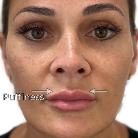 Lip Fillers Migration, Vermillion Border Lip Filler, Filler Migration Lips, Migrated Lip Filler, Lip Filler Swelling Day By Day, Lip Fillers Bruising, Lip Filler Healing Stages, Different Lip Filler Shapes, .5 Lip Filler