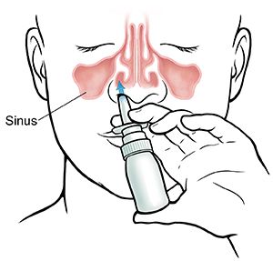 When using nasal spray, keep your chin down and angle the spray away from center. Ear Nose Throat, Nasal Decongestant, Cold Or Allergies, Allergy Medicine, Sinus Problems, Nasal Cavity, Sinus Headache, Nasal Passages, Nasal Spray