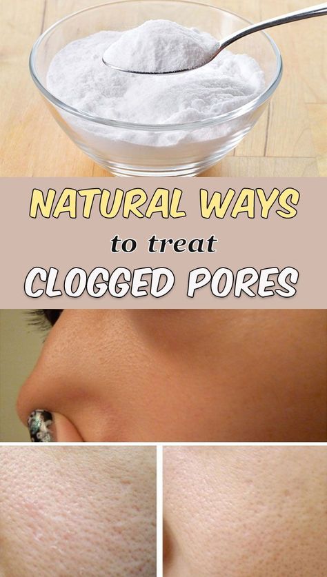 5 natural ways to treat clogged pores | by Moudnibemouaad | Medium Esthetician Treatments, Clean Nose Pores, Get Rid Of Clogged Pores, Brown Spots On Skin, Nose Pores, Pore Mask, Skincare Acne, Brown Spots On Face, Spots On Face