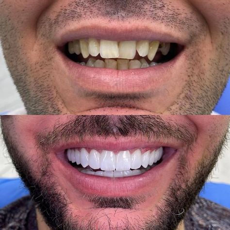 Dental Makeover, Dental Wallpaper, Pretty Teeth, Smile Teeth, Dental Cosmetics, Teeth Care, Healthy Smile, Dental Implants, Dental Clinic