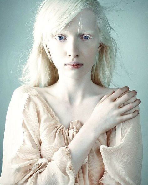 Albinism is a condition some people and animals are born with. This condition is caused by a lack of pigment (colour) in their hair, eyes,… Nastya Zhidkova, Albino Model, Blonde Hair Pale Skin, Albino Girl, White Goth, Super Kawaii, Pigment Coloring, Face Characters, Art Style Inspiration