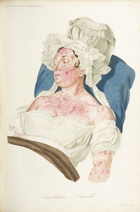 Scarlet Fever, 18th century medical illustration, France. Exhibition, Visualizing Disease Medical Drawings, Male Figure Drawing, Human Figure Drawing, Vintage Medical, Anatomy Drawing, Medical Illustration, Figure Drawing Reference, Male Figure, Medical History