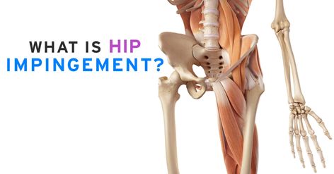 Hip Impingement Exercises, Hip Impingement, Pelvic Floor Muscle Exercise, Bursitis Hip, Core Exercise, Hip Surgery, Muscle Imbalance, Pelvic Floor Exercises, Floor Exercises