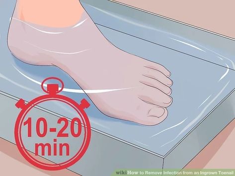 How to Remove Infection from an Ingrown Toenail: 9 Steps Nails Remedies, Aloe Vera For Sunburn, Infected Toenail, Nail Remedies, Home Remedies For Allergies, Antifungal Cream, Natural Remedies For Migraines, Nails 2023 Trends, Ingrown Toenail