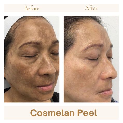 Cosmelan Peel "Reveal your radiant glow with Cosmelan Peel! ✨ Say goodbye to dark spots, pigmentation, and uneven skin tone. Embrace a brighter, smoother complexion today! 🌟💖 Ready to experience the magic? Order now and treat your skin to the best! Website- www.foryoumeditech.in Contact us on- +91-9319931908/ 8178422980 #CosmelanPeel #FlawlessSkin #BrightenUp #GlowFromWithin #EvenSkinTone #SkinTransformation #cosmelanpeel #skinpeeling Cosmelan Peel, Peeling Skin, Uneven Skin, Uneven Skin Tone, Flawless Skin, Even Skin Tone, Dark Spots, Skin Tone, Your Skin