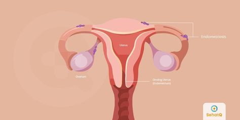 Endometriosis adalah kondisi dimana jaringan endometrium ditemukan di luar rahim. Penyakit ini menyerang organ reproduksi wanita pada usia subur maupun menopause.