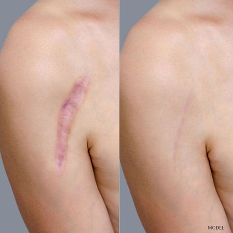 Hate your scars? Talk with us about scar revision to reduce their appearance, please Contact us at 312.757.4505 and discover your options. Scar Aethstetic, Scar Ideas, Scar Reference, Scar Revision, Umibe No Onnanoko, Fake Scar, Hypertrophic Scars, Enough Sleep, Everyday People