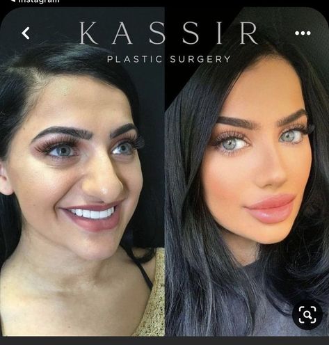 Surgeon Photoshoot, Jaw Reduction Surgery, Nose Plastic Surgery, Celebrity Relationships, Plastic Surgery Fail, Rhinoplasty Nose Jobs, Face Surgery, Plastic Surgery Gone Wrong, Rhinoplasty Before And After