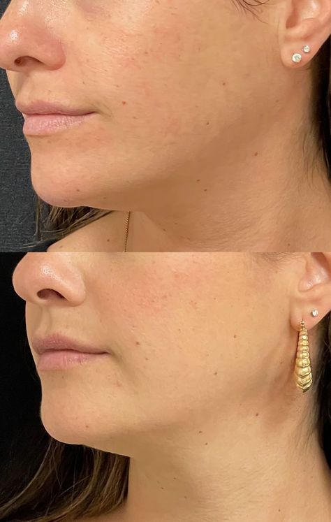 jaw filler before and after Chin Filler, Hyaluronic Acid Fillers, Injectables Fillers, Under The Knife, Natural Facial, Double Chin, Cosmetic Procedures, Dermal Fillers, Dermatology