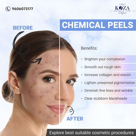 Chemical Peel Benefits, Chemical Face Peel, Best Chemical Peel, Facial Benefits, Acne Laser, Skin Care Center, Skin And Hair Clinic, Skin Facts, Face Peel