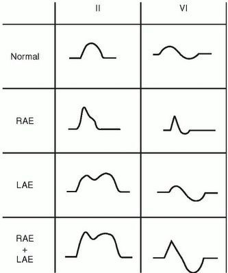 Biphasic P Wave | ... component of p wave in v1 1 5 mm tall and prominent p terminal force Ekg Rhythms, Cardiac Sonography, Medical School Interview, Ekg Interpretation, P Wave, Indian Yoga, Pharmacology Nursing, Respiratory Therapy, Medicine Student