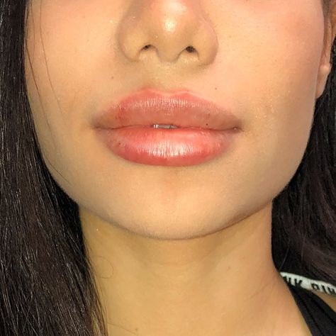 Perfect Pout Juvederm Ultra Plus Filled Lips Dr Todd Round Top Lip, Full Pouty Lips, Perfect Lips Injections, Upturned Lips, Ideal Lips, Bow Shaped Lips Filler, Full Plump Lips Aesthetic, Big Lips Aesthetic, Filled Lips