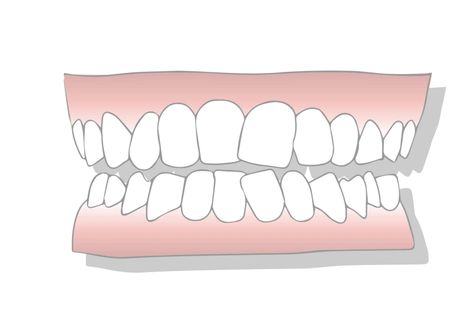 Crowded of teeth ￼ Crowded teeth, also called overcrowding or dental crowding, is when there is not enough space in the mouth for permanent teeth to grow in straight. As a result, people with this form of malocclusion (misalignment) have crooked teeth that overlap each other. Overcrowding can either be mild, moderate, or severe, depending on the patient’s jaw size and how many teeth they have: • Mild Crowding — mild dental crowding is when one anterior tooth in the up Palate Expander, Smile Tips, Tongue Thrust, Impacted Tooth, Crooked Teeth, Kids Teeth, Straight Teeth, Smile Teeth, The Patient