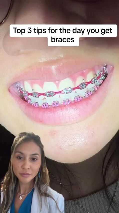 oral care routine steps Braces Tips For School, Dark Purple Braces, Braces Pink, Braces Hacks, Braces Aesthetic, Braces Colours, Pink Braces, Fake Braces, Green Braces