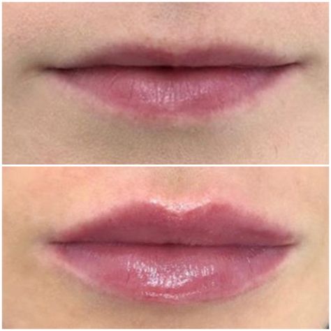 I've Got Small Lips But Im Worried About Getting Lip Fillers - L1P Aesthetics Natural Lip Fillers Small Lips, 1ml Lip Filler, Im Worried, Juvederm Lips, Lips Inspiration, Botox Lips, Light Makeup Looks, Small Lips, Lip Filler