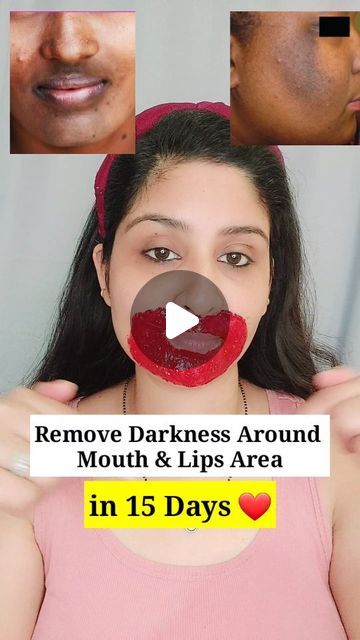 Shalini ♥️ Skin & Hair care 💁‍♀️ on Instagram How To Remove Pigmentation Around Mouth, How To Remove Darkness Around Mouth, Dark Spots Around Mouth, Remove Darkness Around Mouth, Neck Pigmentation, Dark Skin Around Mouth, Darkness Around Mouth, Pigmentation Remedy, Skincare Remedies