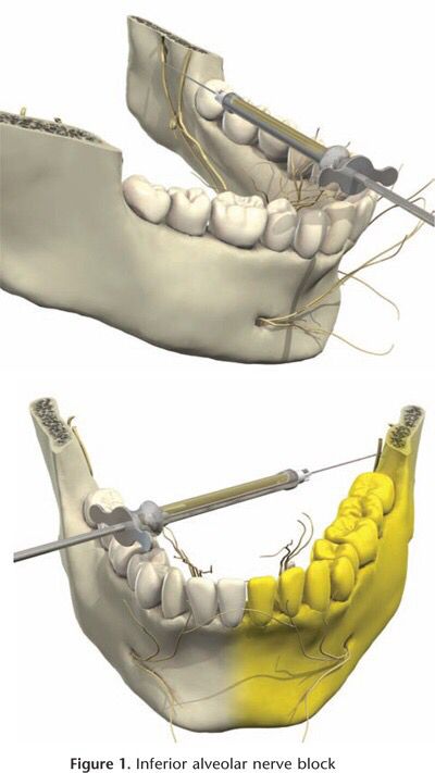 Bloqueo Del Nervio Dentario Inferior En Base a La Técnica De Anestesia Del Mismo Nombre Dental Notes, Dental Assistant Study, Registered Dental Hygienist, Dental Assisting, Dental World, Orthodontic Appliances, Dental Hygiene School, Dentistry Student, Dental Anatomy