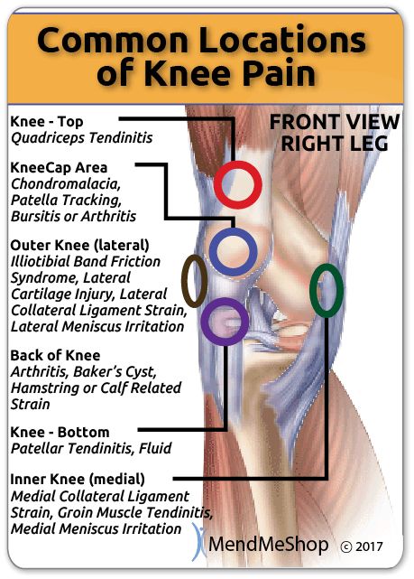 Knee pain can occur at several places in the joint depending on the injury or condition. Patellar Chondromalacia, Common Knee Injuries, Knee Ligament Injury, K Tape, Knee Ligaments, Knee Pain Exercises, Ligament Injury, Knee Exercises, Knee Pain Relief