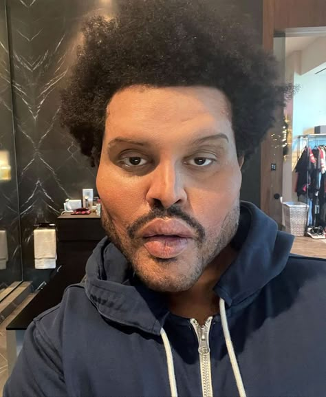 The Weeknd Tattoo, Bloated Face, The Weeknd Memes, Face Transformation, Starboy The Weeknd, Face Surgery, Prosthetic Makeup, Abel Makkonen, Abel The Weeknd