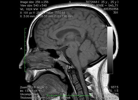 Chiari Malformation, Mri Scan, Irritable Bowel, Rare Disease, Signs And Symptoms, Neck Pain, Migraine, Headache, Signs