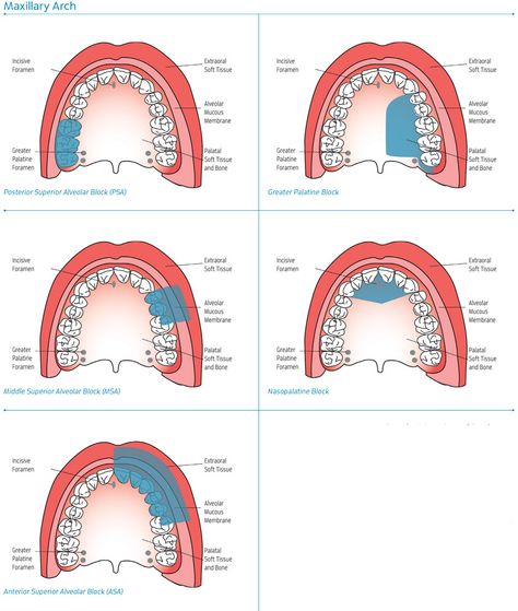 Maxillary Injection Sites Dental Anesthesia Injection Sites, Dental Anesthesia Injection, Coronal Polishing Dental, Dental Assistant School, Injection Sites, Dental Hygienist School, Local Anesthesia, Hygiene School, Dental Assistant Study