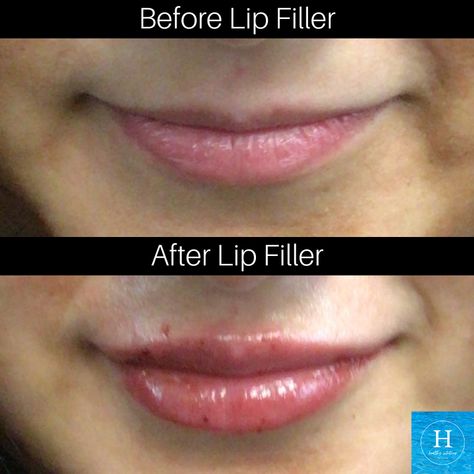 Lip Filler Before and After Lip Augmentation, Bucks County Pa, Lip Filler, Botox Injections, Sms Text, Lip Injections, Cosmetic Procedures, Upper Lip, Medical Spa