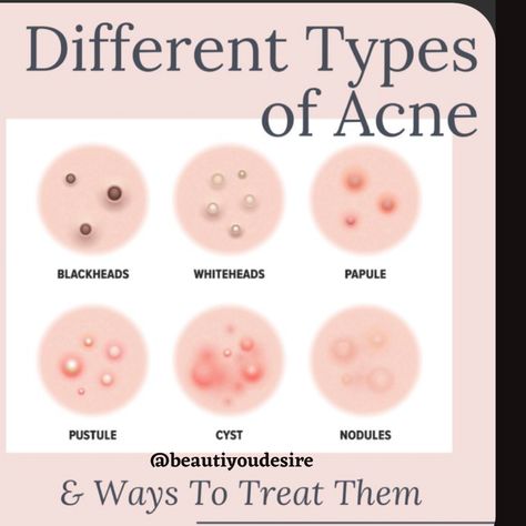 Different types of ACNE Papules Acne, Oily Nose, Nodule Acne, Skin Types Chart, Comedonal Acne, Light Olive Skin, Scar Remedies, Different Types Of Acne, Men Skin Care Routine