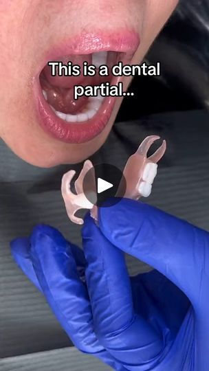 Partial Dentures Before And After, Dentures Before And After Immediate, Dental Dentures, Dental Videos, Partial Dentures, Missing Teeth, Dentures, Tiktok Video, Health