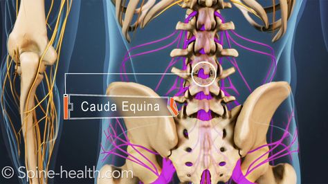 Cauda equina syndrome is a relatively rare but serious condition that describes extreme pressure and swelling of the nerves at the end of the spinal cord. Cauda Equina Symptoms, Spinal Compression, The Spine Spg, Tracts Of Spinal Cord, Ascending And Descending Tracts Of Spinal Cord, Severe Lower Back Pain, Cauda Equina, Sciatica Symptoms, Severe Back Pain