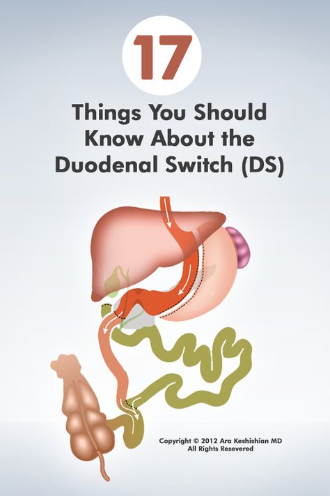 Bariatric Recipes Ds Loop, Duodenal Switch Surgery, Bariatric Recipes Duodenal Switch, Duodenal Switch Diet, Modified Duodenal Switch, Duodenal Switch Before And After, Duodenal Switch Recipes, Full Liquid Diet, Duodenal Switch